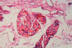 Jódhiány okozta golyvában szenvedő emberi pajzsmirigy sejtjei mikroszkóp alatt
